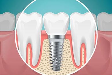 Dantų ir implantai