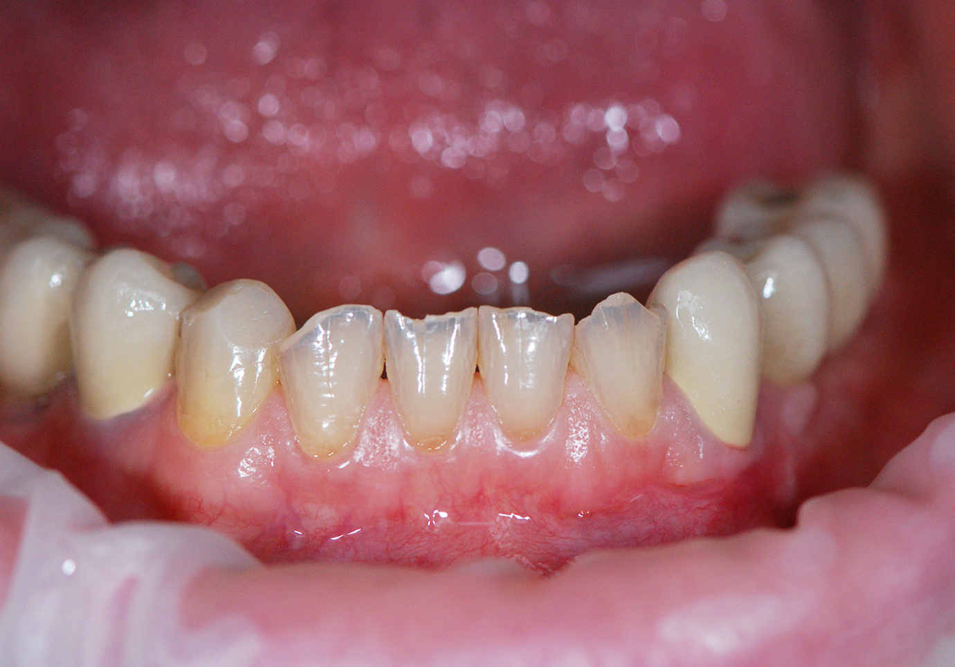 Estetinis dantų plombavimas